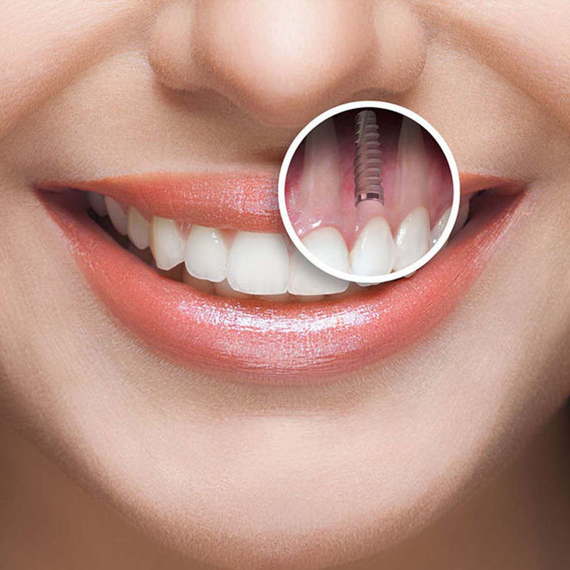 Implant Dentaire